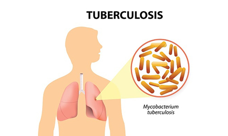 tuberculose